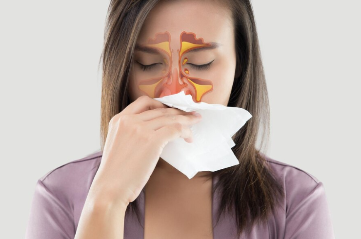 Sinusitis