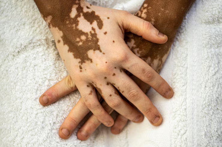 Vitiligo